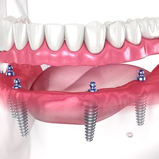 Close-up illustration of removable implant denture