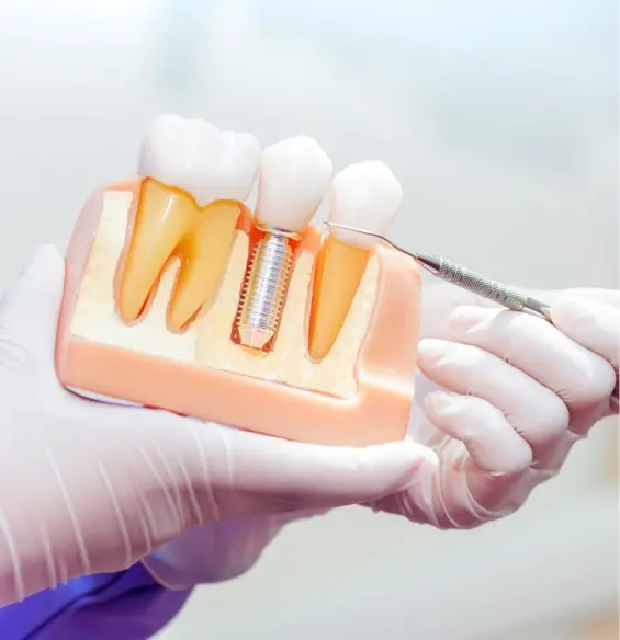 A person holding a tooth implant in their hand.