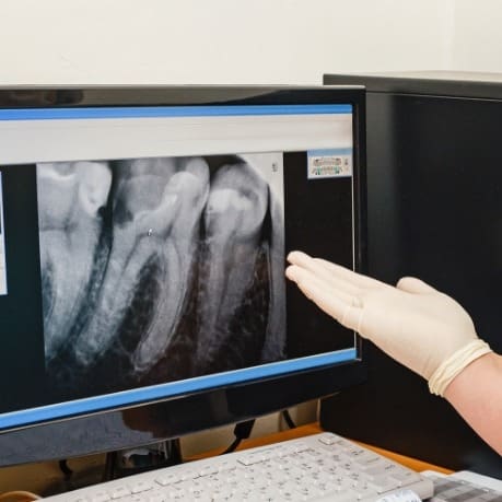 A person pointing to an x-ray on the computer screen.