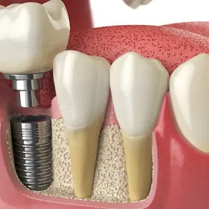 A close up of the teeth and implant