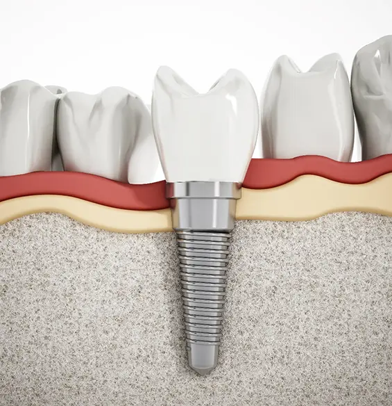 A close up of the tooth implant in its place