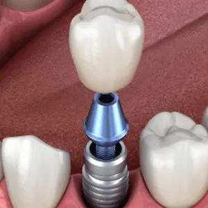 A dental implant being placed into the tooth of another person.