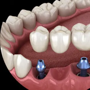 A close up of an implant supported denture