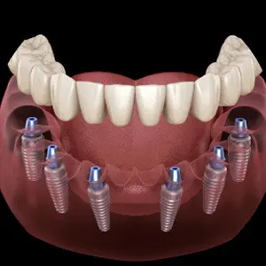 A close up of an implant retained denture