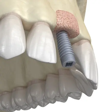 A close up of the tooth with an implant