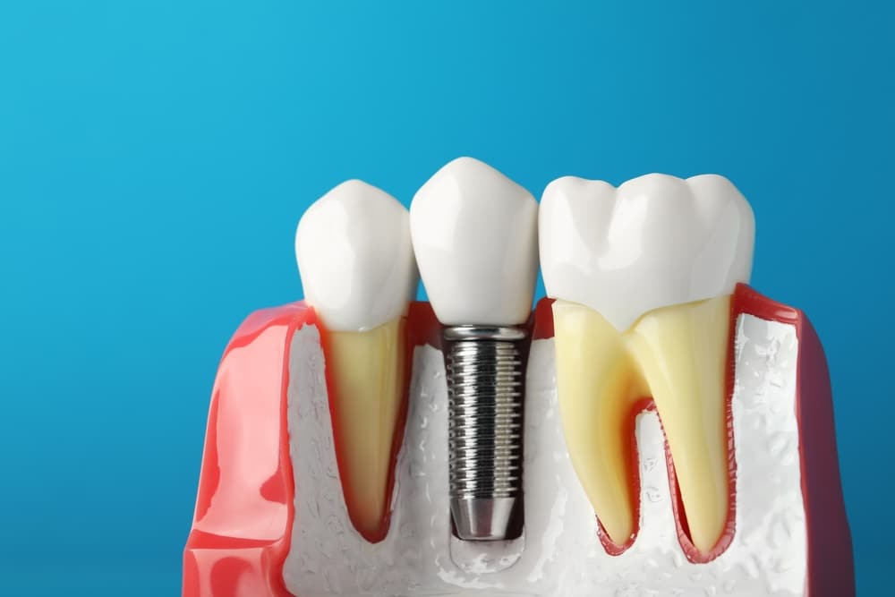 A-model-of-a-lower-jaw-showing-a-dental-implant-along-with-natural-teeth-on-a-blue-background