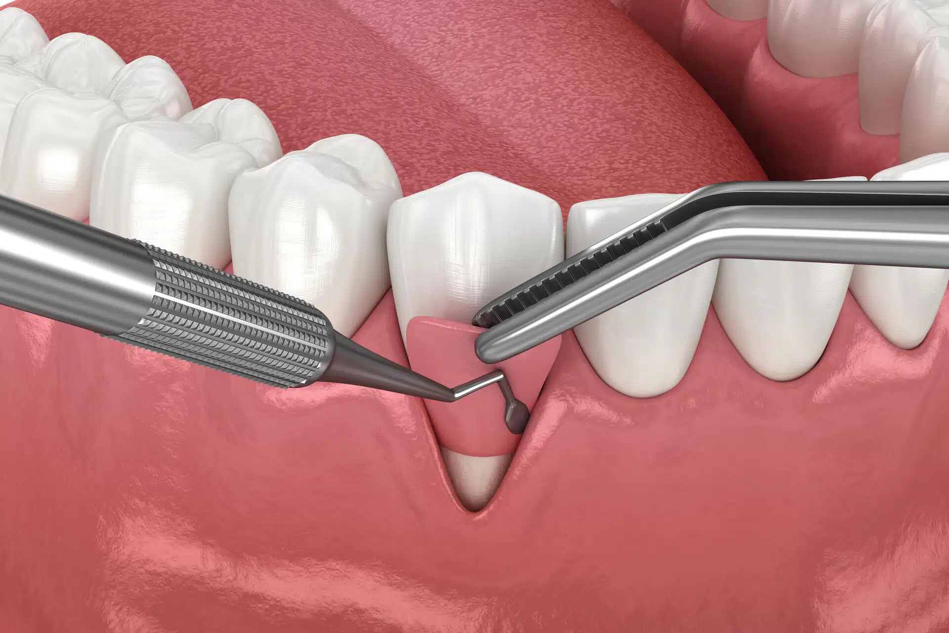 Illustration-on-gum-graft-surgery.jpg