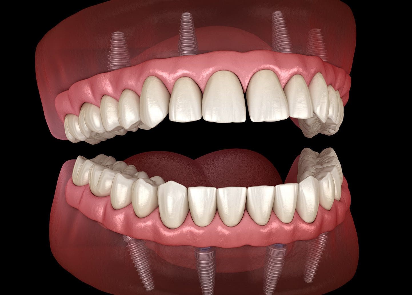 all-on-4-dental-implants-img1