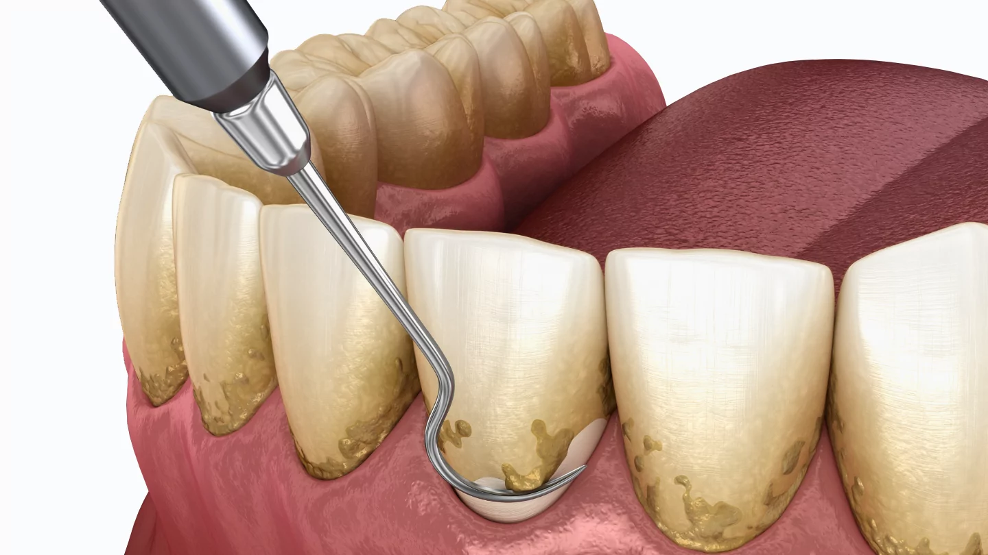what-is-periodontal-therapy.png