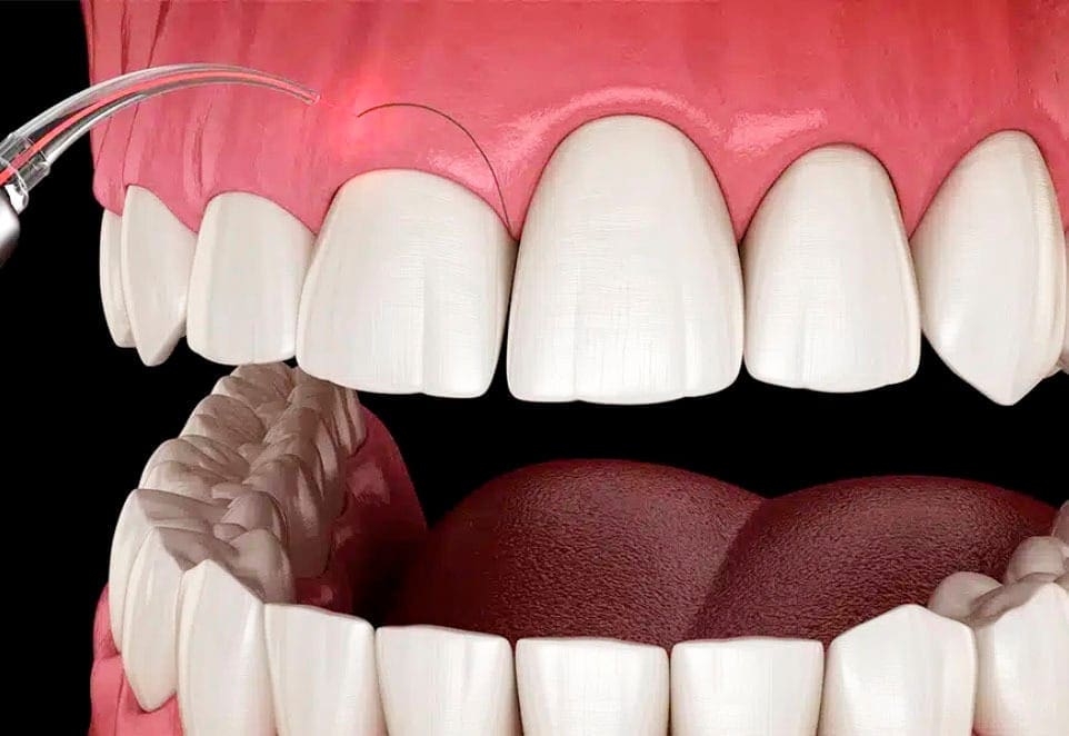 Crown-Lengthening-in-chicago