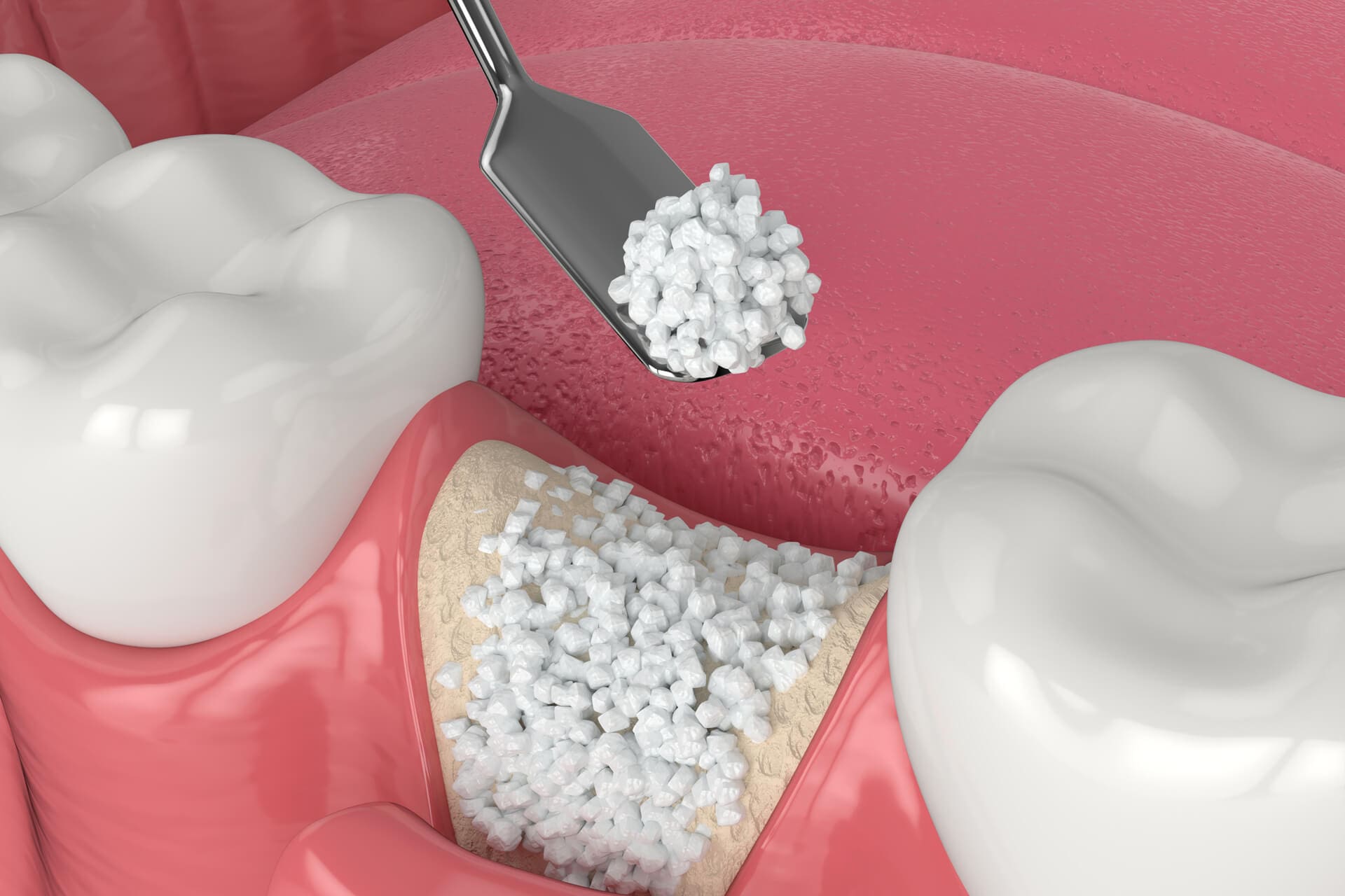 Illustration-of-dental-bone-grafting-with-bone-biomaterial-application